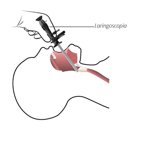 laringoscopico|Laryngoscopy